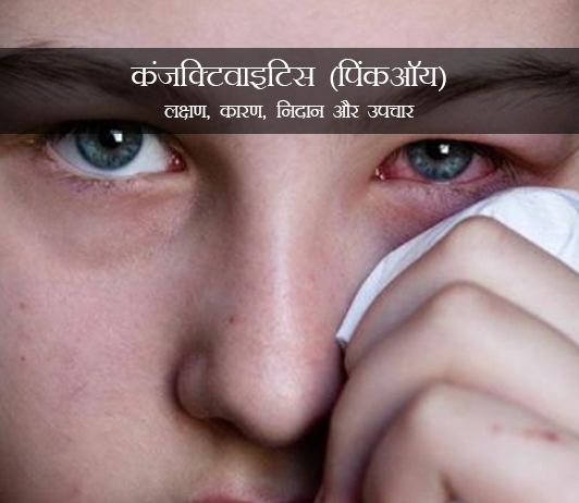 Conjunctivitis in Hindi Conjunctivitis in Hindi