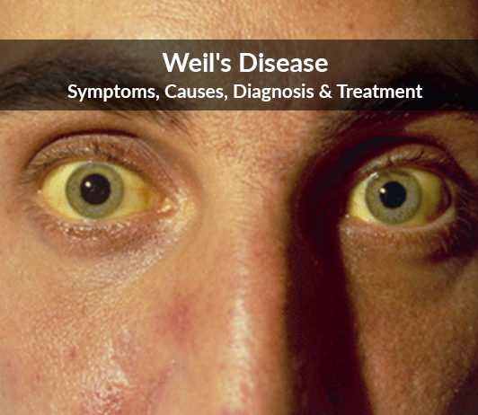 Weil's Disease (Leptospirosis)- Symptoms, Causes, Diagnosis & Treatment Leptospirosis (Weil’s Disease): Symptoms, Causes, Diagnosis & Treatment