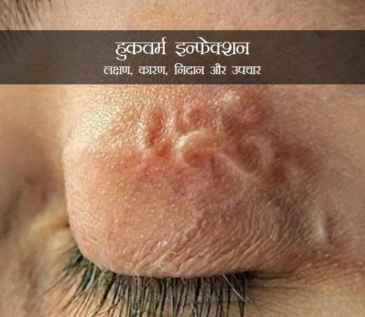 Hookworm Infection in Hindi