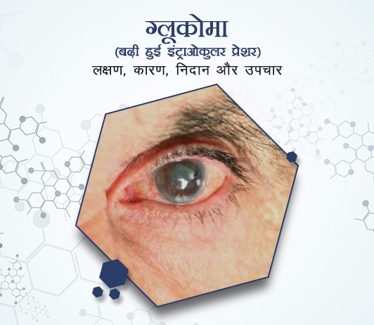 Glaucoma in Hindi Glaucoma in Hindi