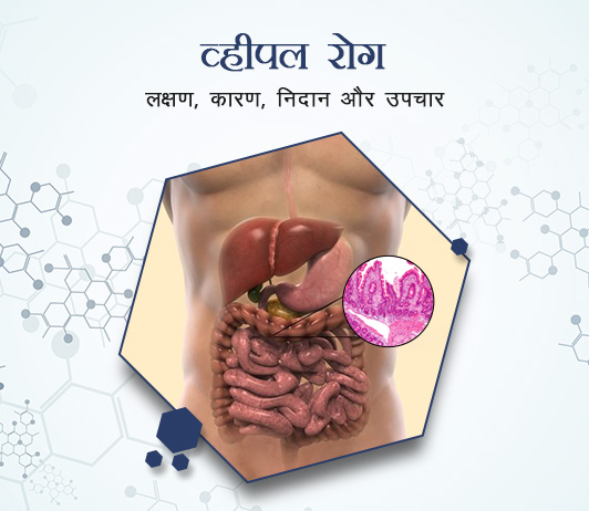 Whipple’s Disease in Hindi Whipple’s Disease in Hindi