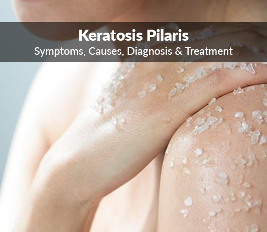 Keratosis Pilaris (Follicular Keratosis)- Symptoms, Causes, Diagnosis & Treatment Follicular Keratosis (Keratosis Pilaris): Symptoms, Causes, Diagnosis & Treatment