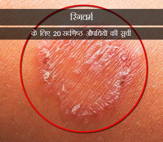 10 Medicines for Ringworm in Hindi रिंगवर्म के लिए 20 सर्वश्रेष्ठ औषधियों की सूची - संरचना, खुराक, लोकप्रियता (2019)
