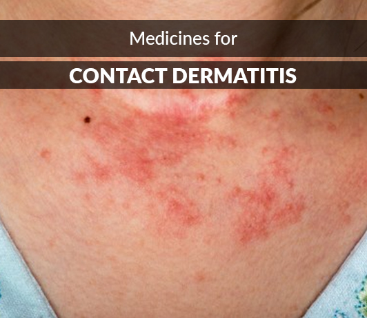 4 List of 20 Best Medicines for Contact Dermatitis – Composition, Dosage, Popularity & More (2019)