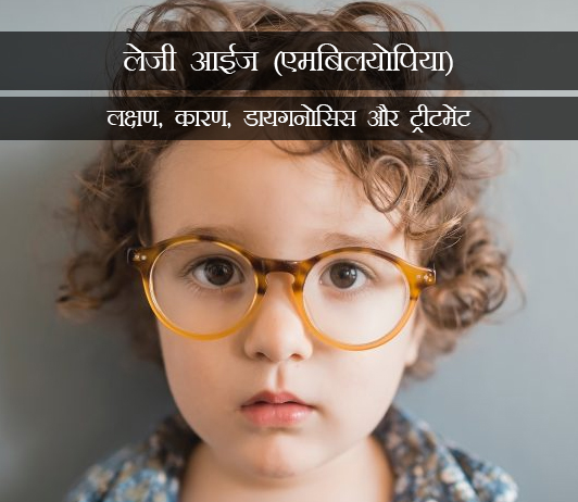 7 Lazy Eye (Amblyopia)in Hindi लेजी आईज (एमबिलयोपिया): लक्षण, कारण, डायगनोसिस और ट्रीटमेंट