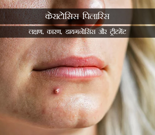 8 Follicular Keratosis (Keratosis Pilaris) in Hindi फोलिकुलर केराटोसिस (केराटोसिस पिलारिस): लक्षण, कारण, डायगनोसिस और ट्रीटमेंट